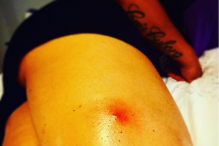 Cris Cyborg Deixa O Hospital Aps Ser Picada Por Aranha Viva Negra